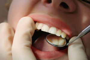 Soigner la parodontite - Coutances